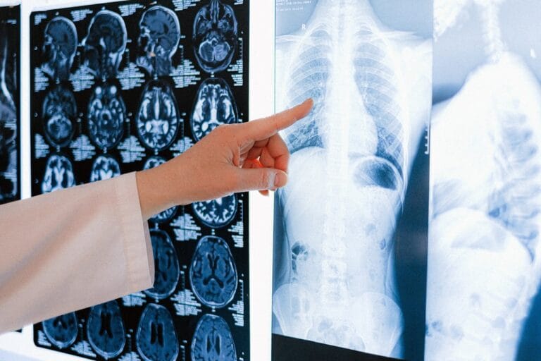 Doctor reading lung cancer x-ray