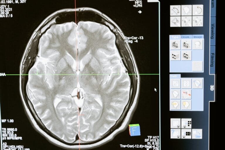 Precision brain scan showing what a full body MOT should include when using advanced 3 Tesla MRI technology.